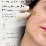 جوانسازی و بهبود کیفیت پوست با مزو PRP