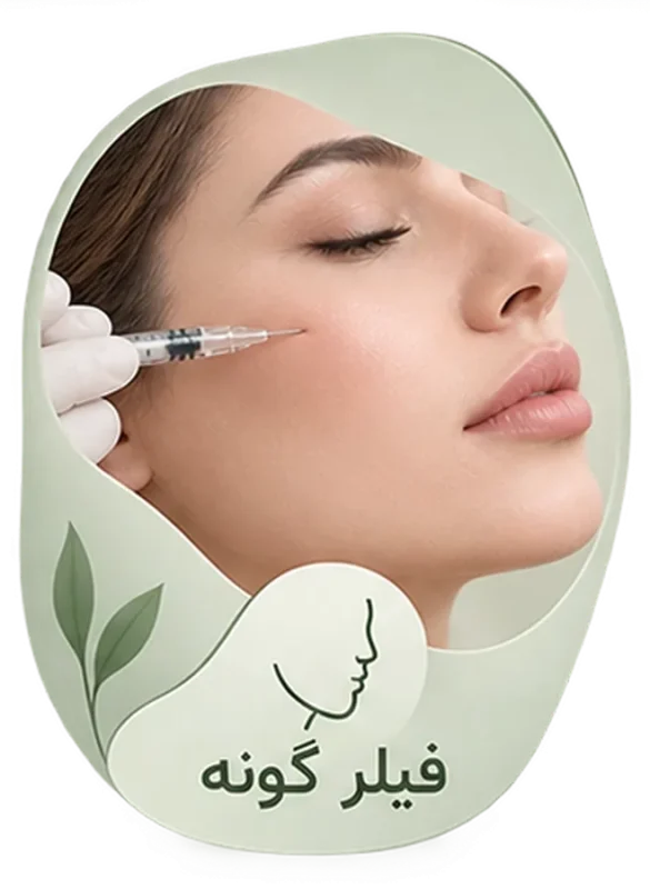 Cheek filler